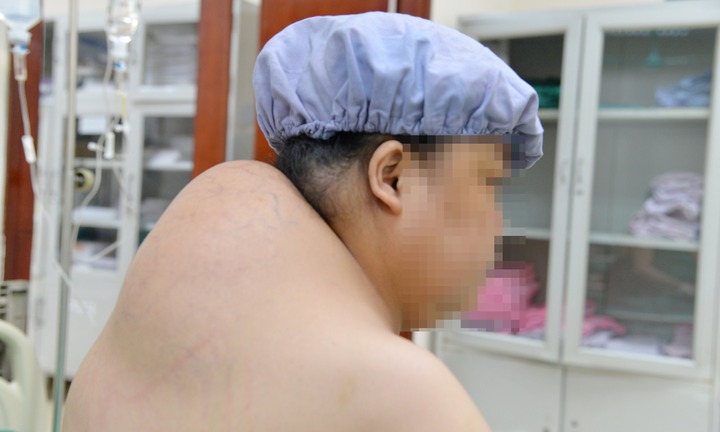 Người phụ nữ 10 năm ‘vác’ khối u khổng lồ sau gáy