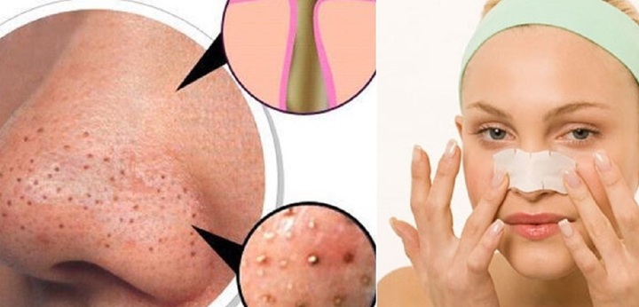 Nặn mụn đầu đen ở mũi thế nào cho đỡ hại da?