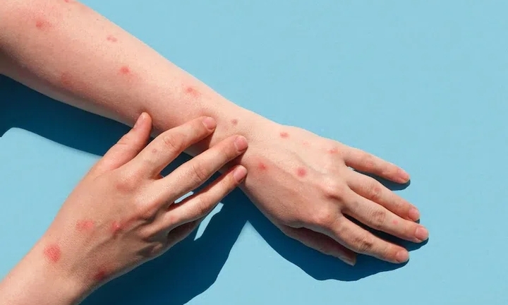 93% các ca mắc đậu mùa khỉ ở Việt Nam là nam giới