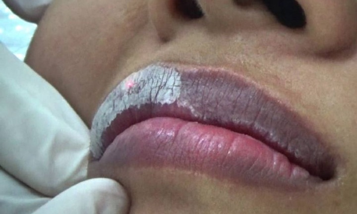 Sau khi khử thâm môi nên kiêng ăn gì?