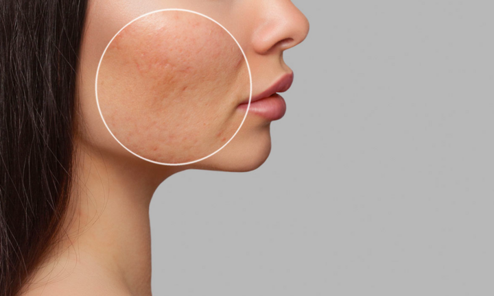 Nguyên nhân gây bít lỗ chân lông