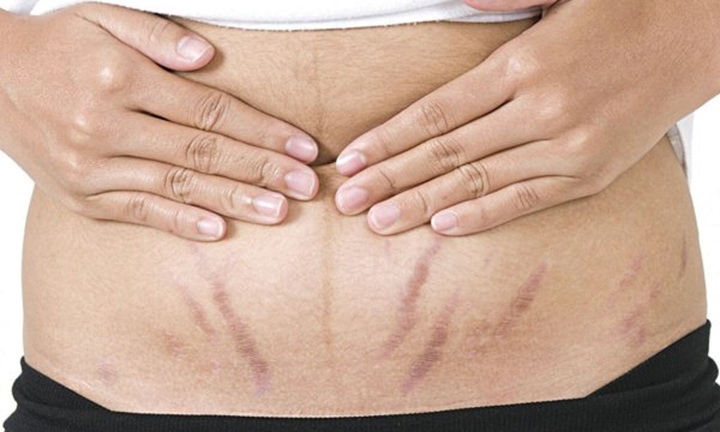 Cách chăm sóc da bụng sau khi sinh