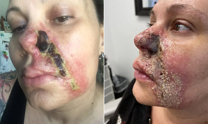 Nghiện tiêm filler, người phụ nữ bị mục nát và rụng một bên mũi