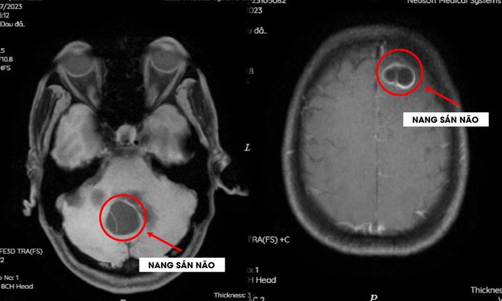 Sán làm tổ trong não do thói quen ăn tiết canh