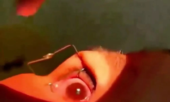 Hơn 60 con giun bò ngoe nguẩy trong mắt người phụ nữ