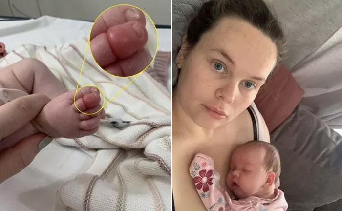 Em bé sơ sinh suýt mất ngón chân chỉ vì sợi tóc của mẹ
