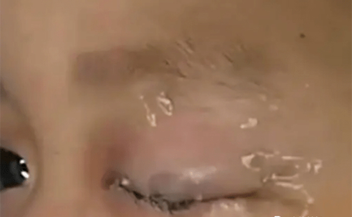 Cậu bé nhỏ keo 502 vào mắt, cách xử lý của người cha được bác sỹ khen ngợi