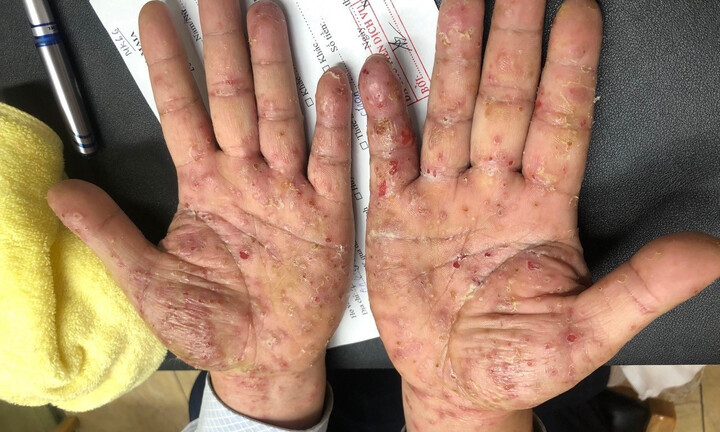 Chồng đi công tác về, cả nhà bị ghẻ