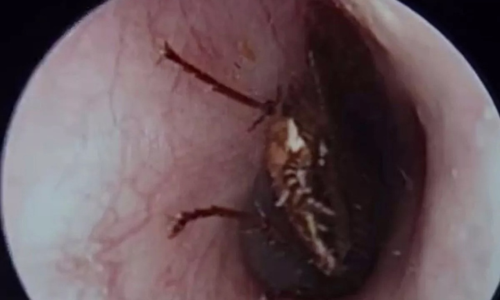 Gián bò vào tai con, mẹ xử lý thông minh giúp bé thoát nạn