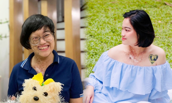 ‘Cô gái chỉ có nửa khuôn mặt’ lột xác sau 3 cuộc đại phẫu