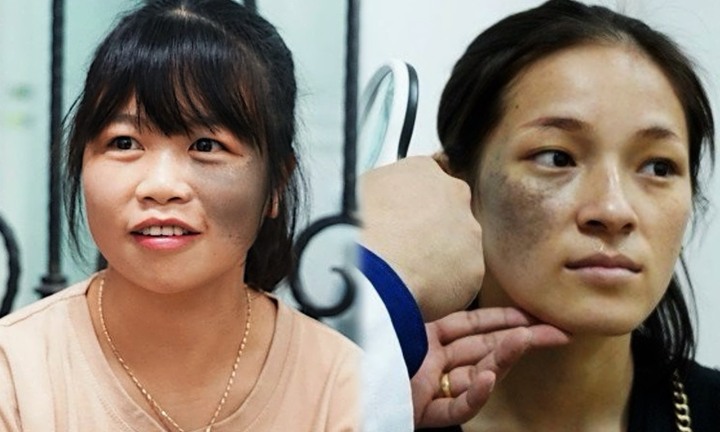 Nỗi khổ của người mẹ trẻ bị vết bớt chiếm nửa khuôn mặt