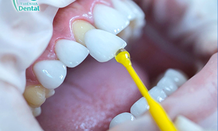 Công nghệ Xsmile - đột phá mới trong bọc răng sứ không mài nhỏ tại Thiên Hà