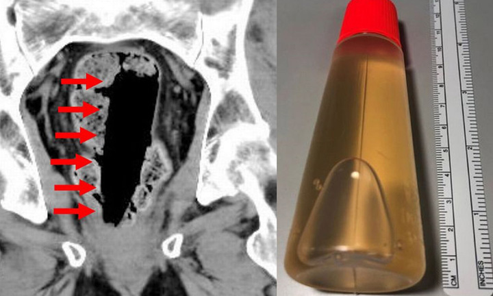 Người đàn ông bất tỉnh trong bồn tắm khi chữa táo bón bằng cách 'kinh dị'