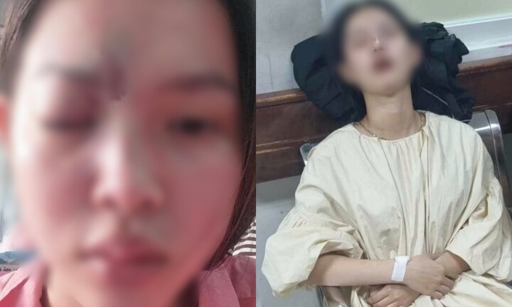 Cô gái trẻ ở Đồng Nai bị mù mắt sau khi tiêm filler: Công an vào cuộc