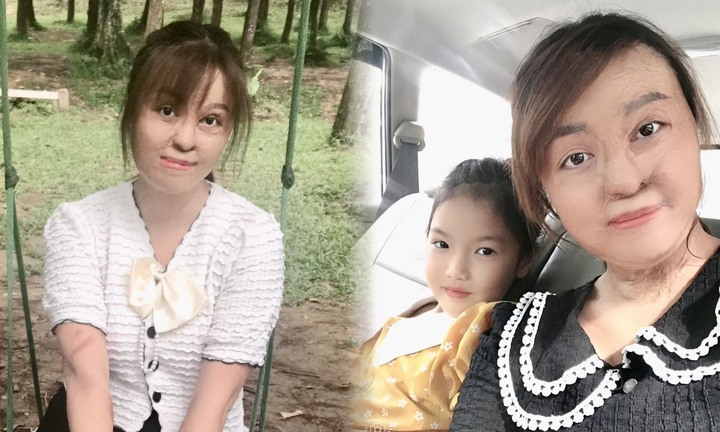 Sau 20 lần mổ, cô gái bị chồng đổ xăng đốt hôm mùng 2 Tết hiện ra sao?