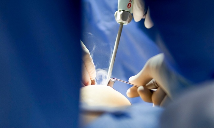 Những điểm cần lưu ý khi nâng ngực bằng dao siêu âm thế hệ mới