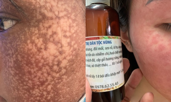 Mua mỹ phẩm trên mạng làm đẹp cấp tốc, nhiều người mất Tết vì biến chứng