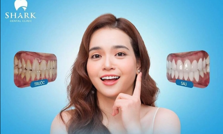 Giá dán sứ Veneer ưu đãi 50% tại Nha khoa Shark