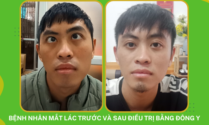 Phương pháp điều trị mắt lác nào an toàn và hiệu quả?