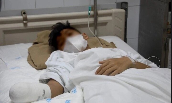 Nghịch pháo ngày Tết, thiếu niên mất bàn tay phải 