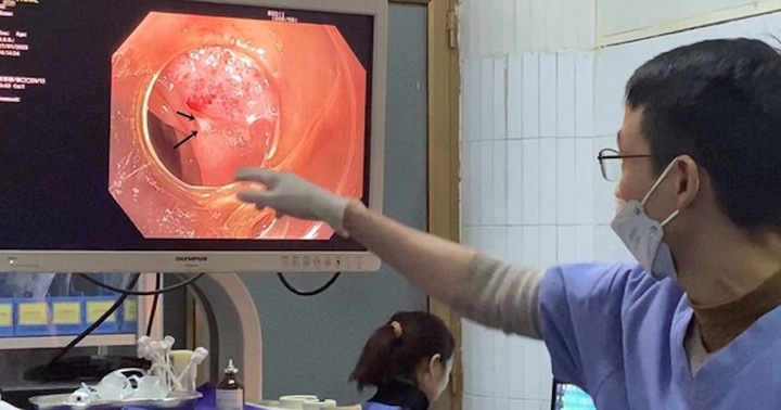 Nuốt phải tăm tre, cô gái bị thủng ruột non