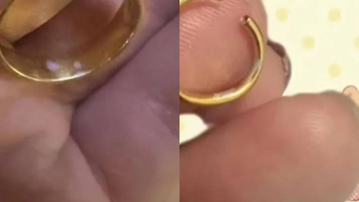 Cô gái phát hiện mối nguy hiểm chết người trong túi nhờ nhẫn vàng đổi màu