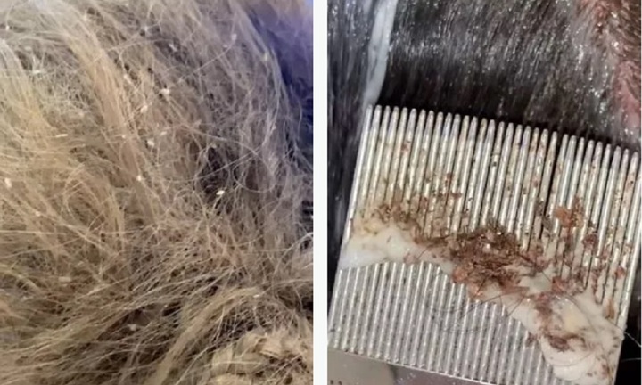 Cô gái khiến dân mạng rùng mình vì clip xử lý những mái tóc lúc nhúc chấy rận