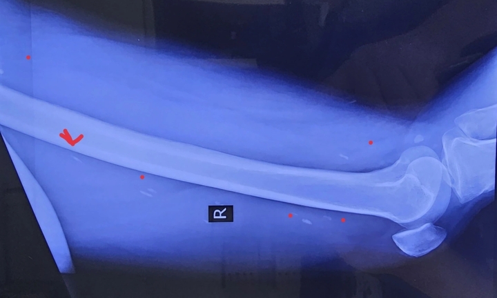 Sán chi chít trong người từ thói quen ăn đồ tái, sống