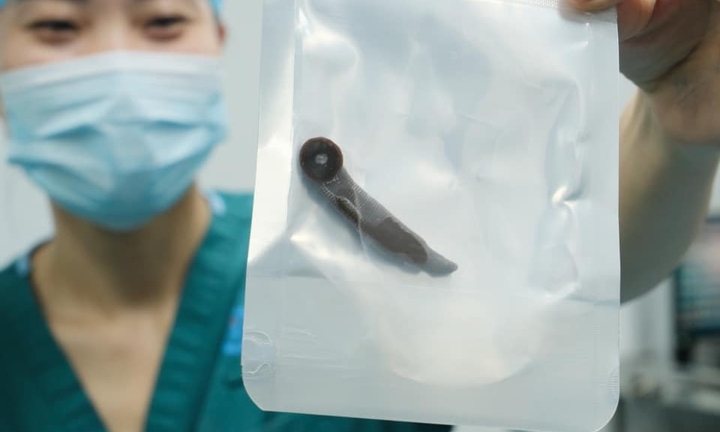 Nhai nắm cỏ đắp vết đứt tay, người đàn ông bị đỉa dài 6 cm chui vào cổ họng