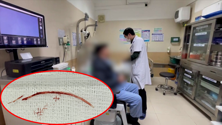 Hy hữu người đàn ông mắc xương cá dài 3,5 cm ở tai 