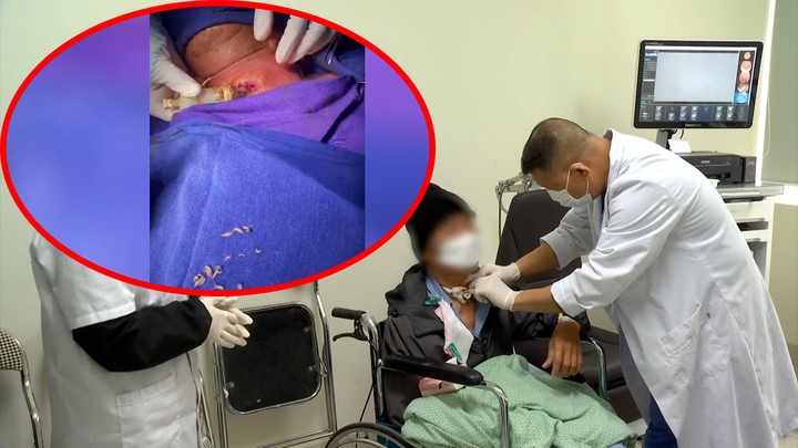 Hy hữu bác sĩ gắp 30 con giòi làm tổ trong cổ họng bệnh nhân