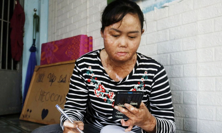 Sau hàng chục ca mổ, người phụ nữ bị chồng đổ xăng đốt bỏng 92% hiện ra sao?