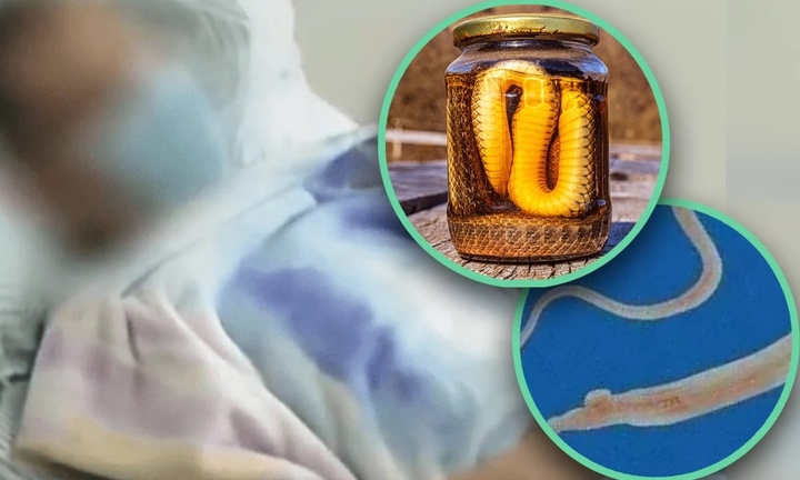 Ăn mật rắn, uống rượu rắn, người đàn ông nhiễm trùng tuỷ sống nghiêm trọng