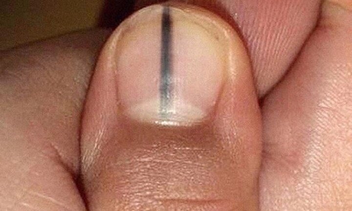 Móng tay xuất hiện sọc đen có phải ung thư da?