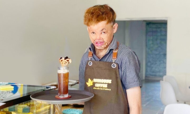 Bị bỏng biến dạng cơ thể, chàng trai hồi sinh sau 20 lần phẫu thuật