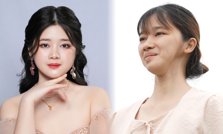 Cô gái 'mặt lõm' lột xác sau 4 cuộc đại phẫu