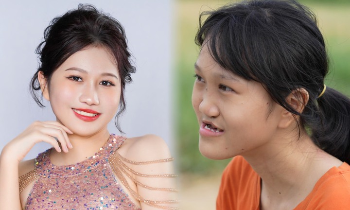 Cuộc sống của cô gái hở hàm ếch sau 2 lần mổ tái tạo gương mặt
