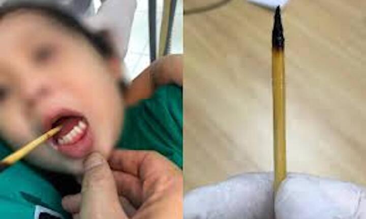 Bé 3 tuổi bị que xiên thịt đâm xuyên lưỡi sau cú ngã