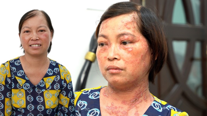 Hành trình 'thay da' cho người phụ nữ 10 năm bị bong vảy khắp cơ thể 