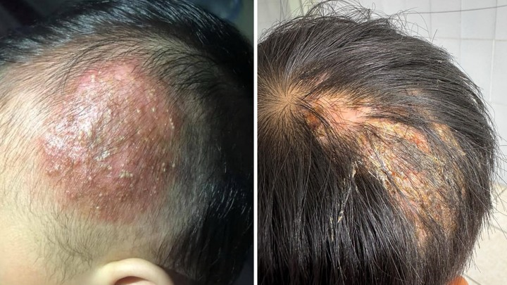 Lây nấm từ chó mèo, bé trai 9 tuổi đầu lở loét