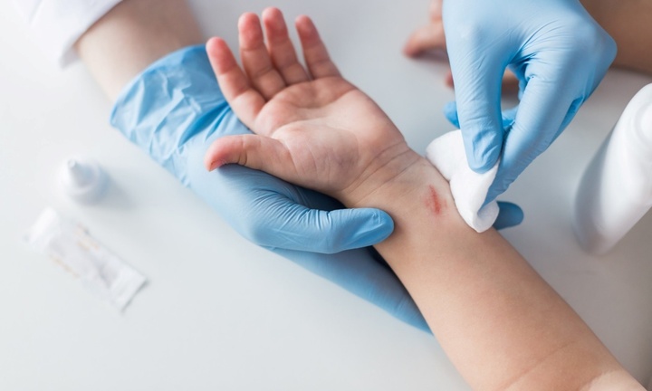 Chăm sóc vết thương, đừng để có sẹo mới lo xử trí