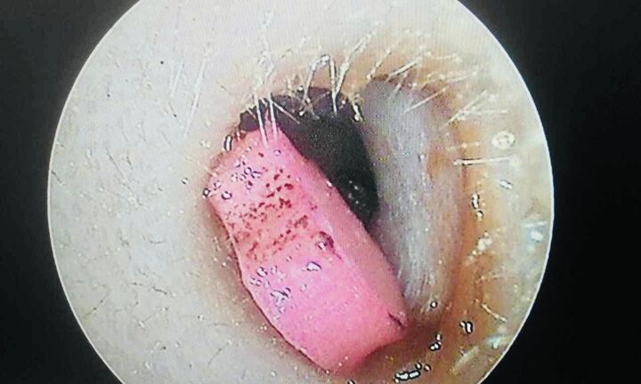 Bé 6 tuổi sốt nhập viện, bác sĩ phát hiện cục tẩy trong tai