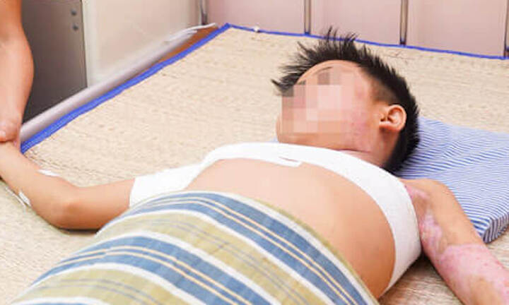 Trèo cột điện cao thế bắn chim, bé trai 11 tuổi bị giật bỏng nặng