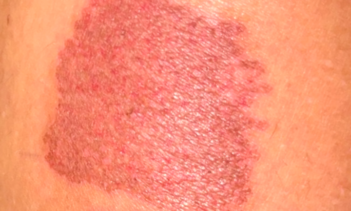 Biến chứng có thể gặp khi điều trị tĩnh mạch bằng laser xung dài