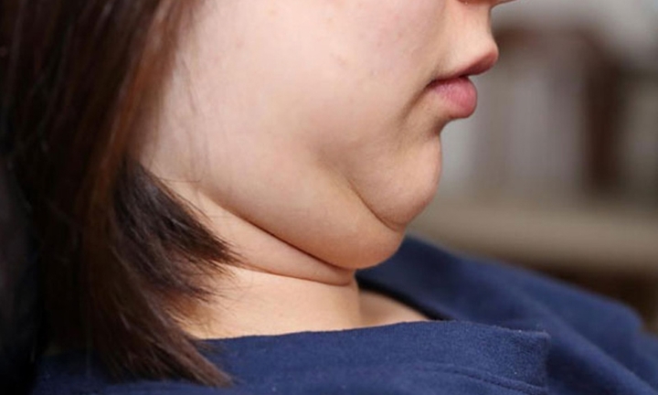 5 mẹo đơn giản giúp bạn giảm mỡ mặt mà không cần động dao kéo