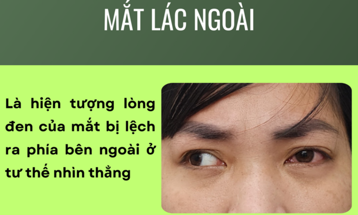 Giải thích hiện tượng 'Mắt lác ngoài'