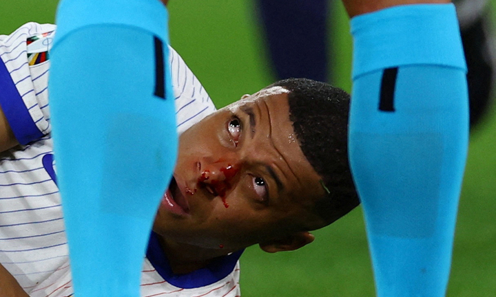 Cận cảnh pha va chạm khiến Mbappe đổ máu, đến thẳng bệnh viện