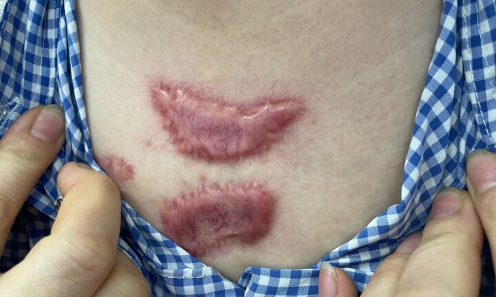 Chi hàng chục triệu trị sẹo, kết quả gặp biến chứng phải tìm bác sĩ