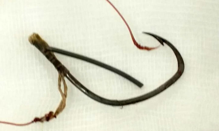 Người phụ nữ bị lưỡi câu cá găm vào mắt 