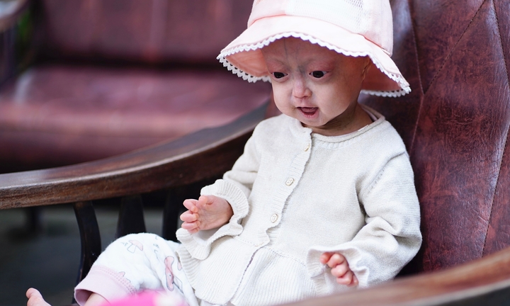 Cuộc sống hiện tại của bé gái mắc chứng 'vừa chào đời đã già'